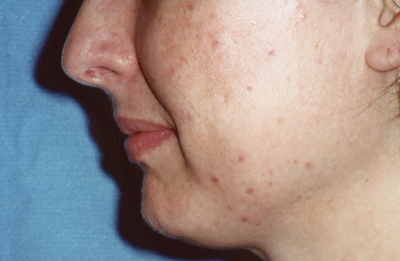 chin augmentation before
