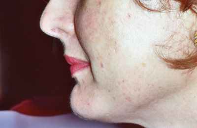 chin augmentation after