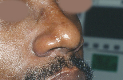 Rhinoplasty After