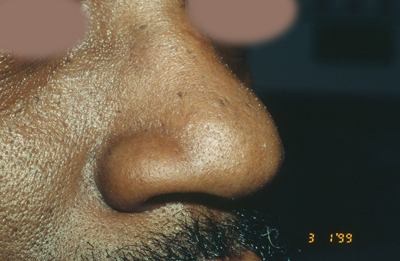 Rhinoplasty Before