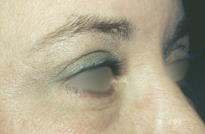 eyelid lift after