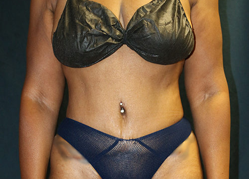 liposuction after