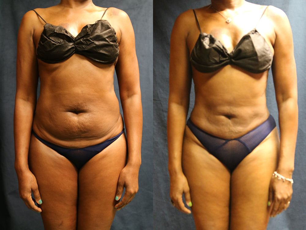 Before and after photo of a liposuction patient.