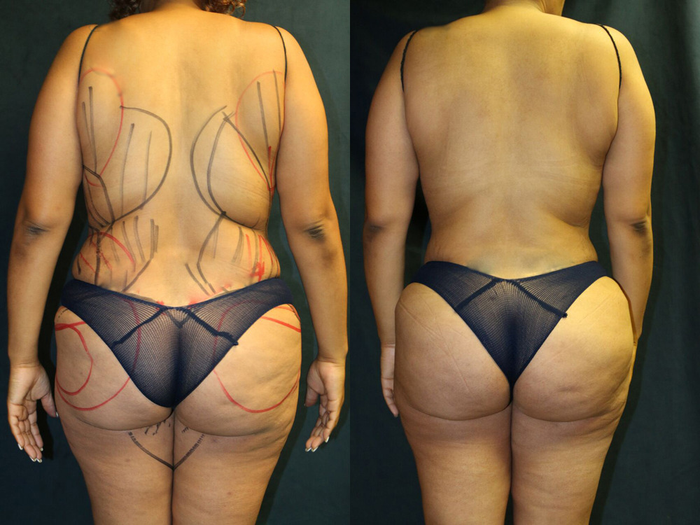 Before and after photo of a liposuction patient.