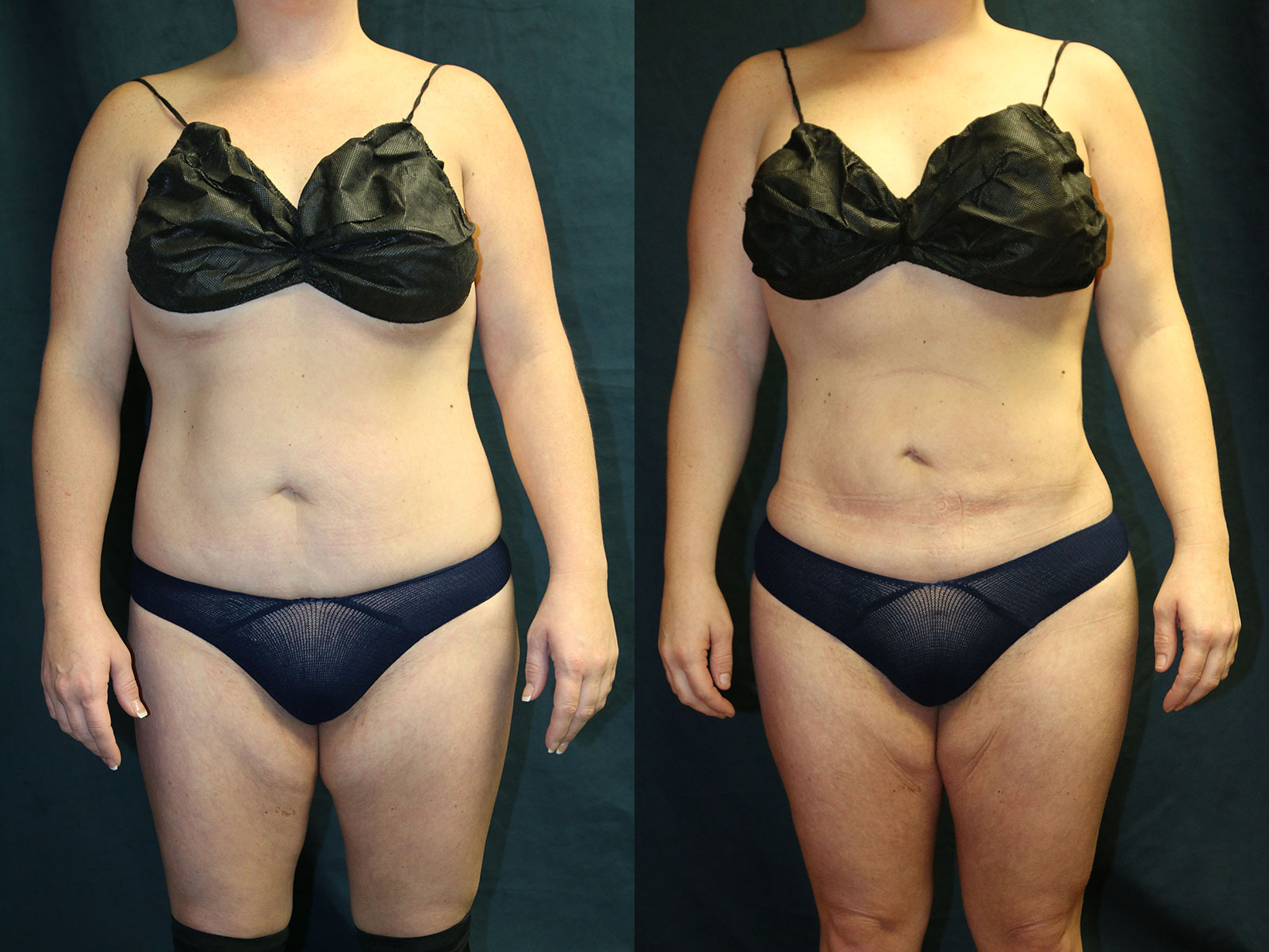 Before and after photo of a liposuction patient.