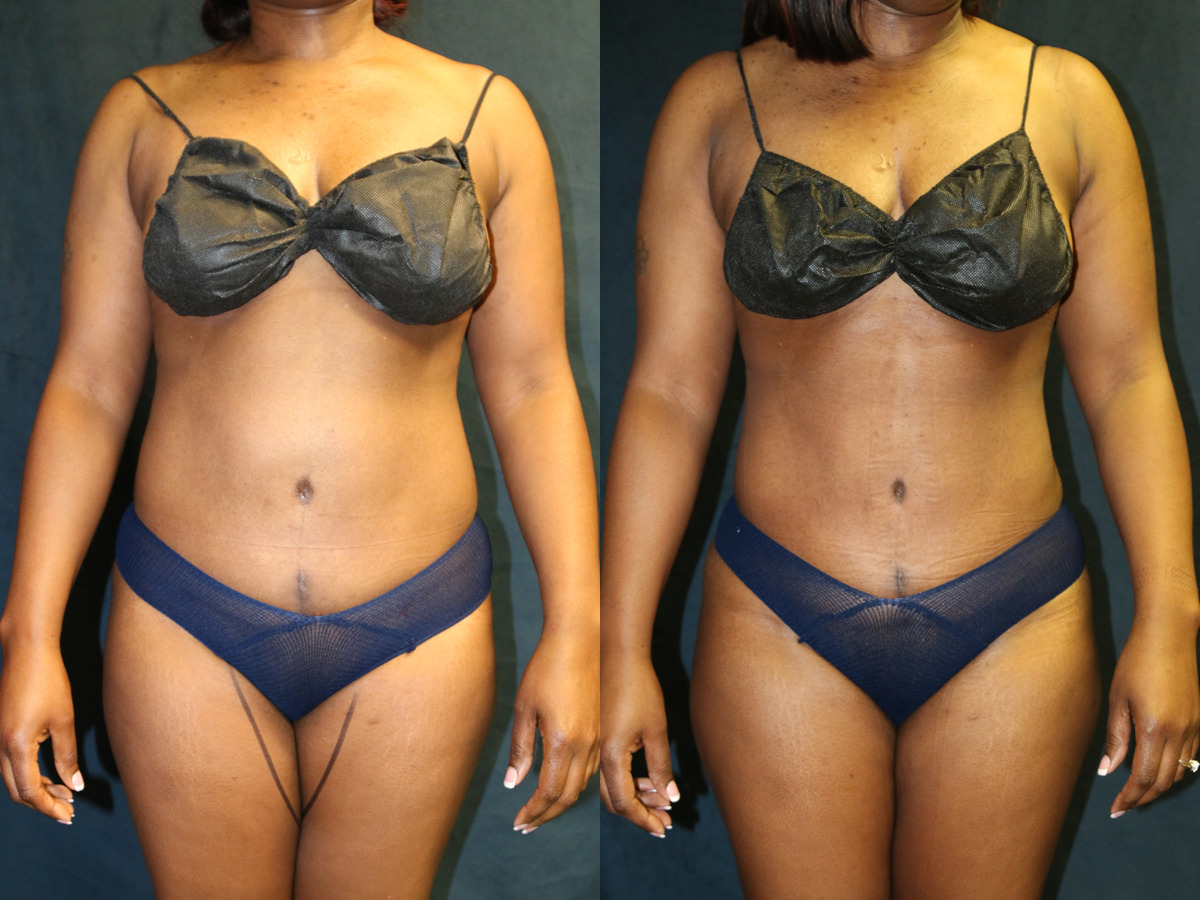 Before and after photo of a liposuction patient.