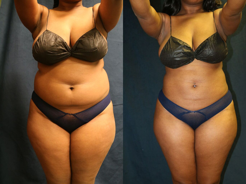 Before and after photo of a liposuction patient.