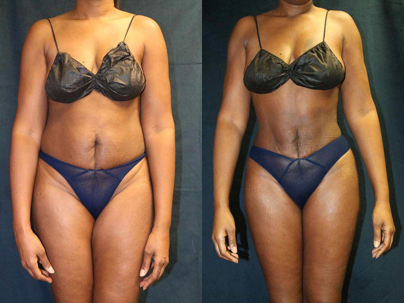 Before and after photo of a liposuction patient.