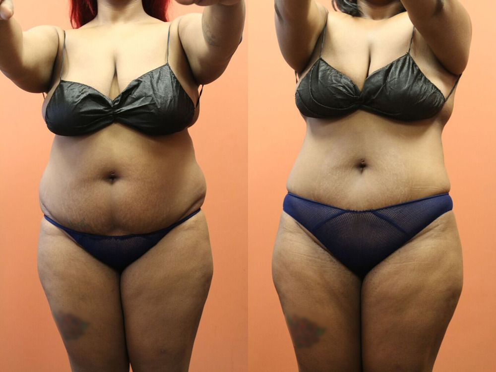 Before and after photo of a liposuction patient.