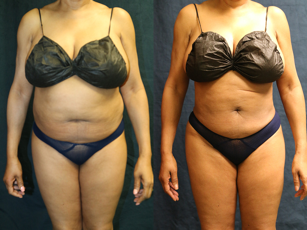 Before and after photo of a liposuction patient.