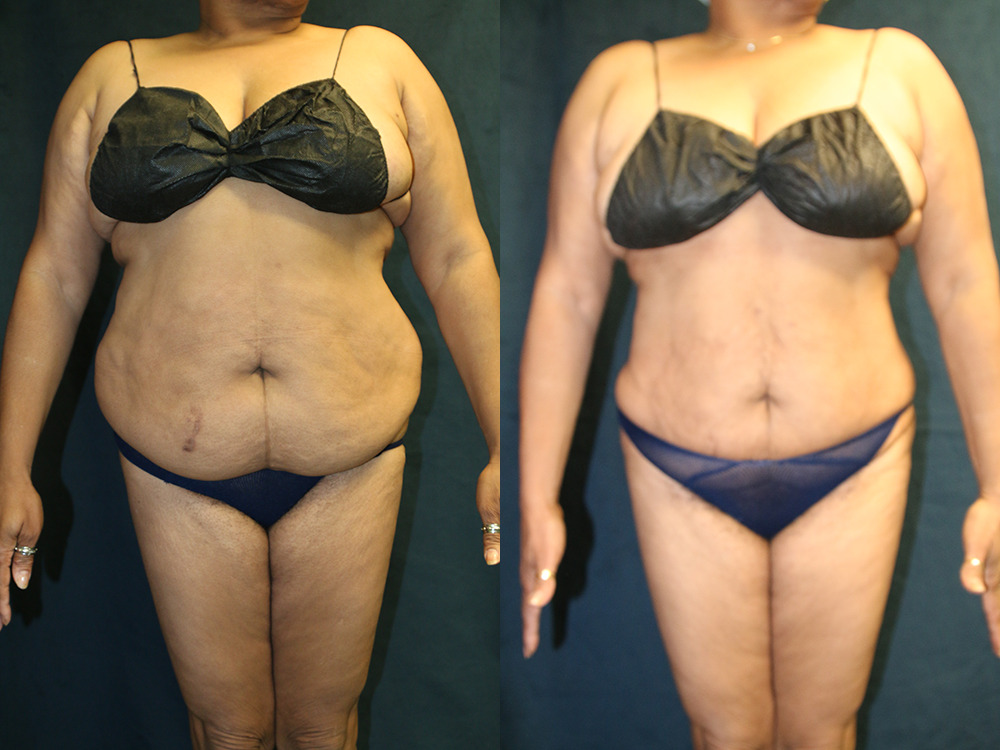 Before and after photo of a liposuction patient.