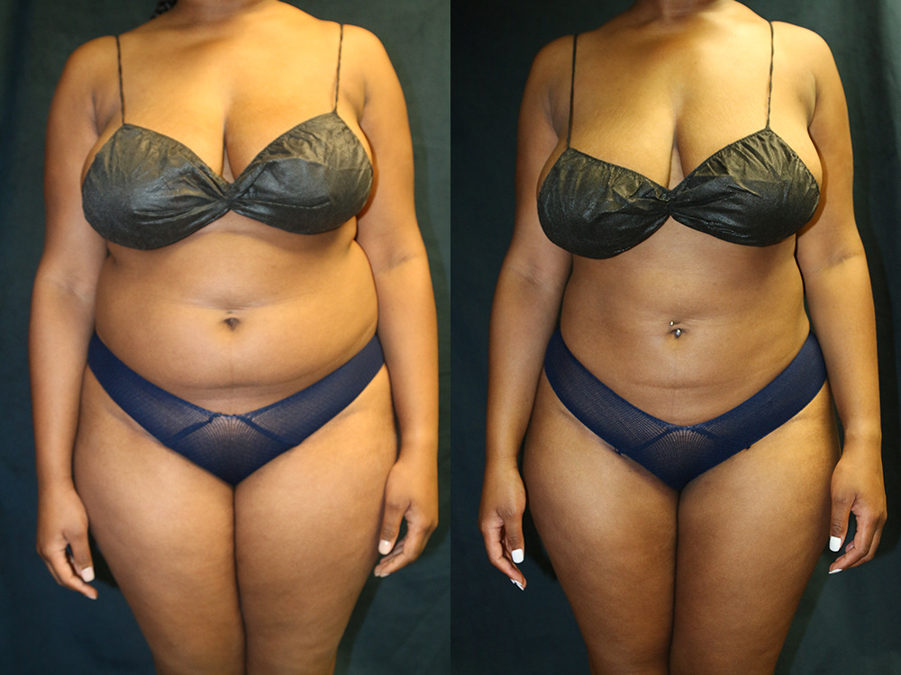 Before and after photo of a liposuction patient.