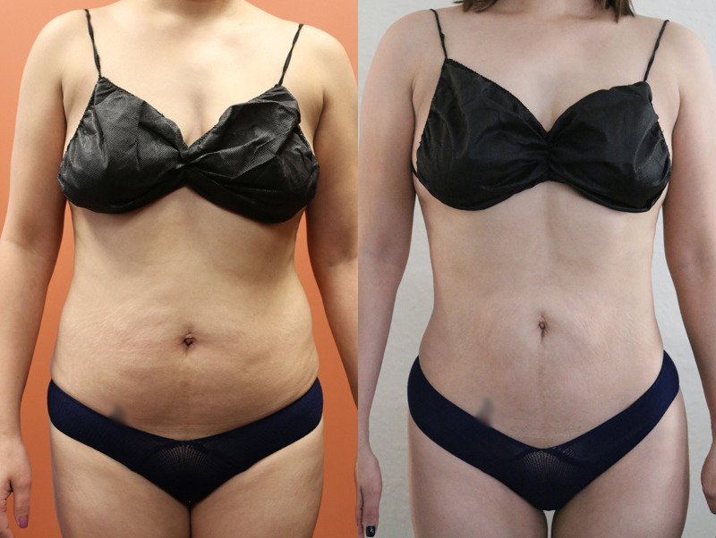Before and after photo of a liposuction patient.