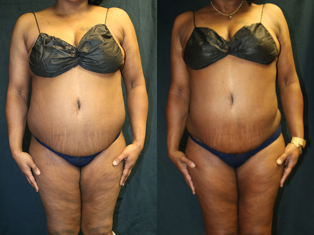 Before and after photo of a liposuction patient.