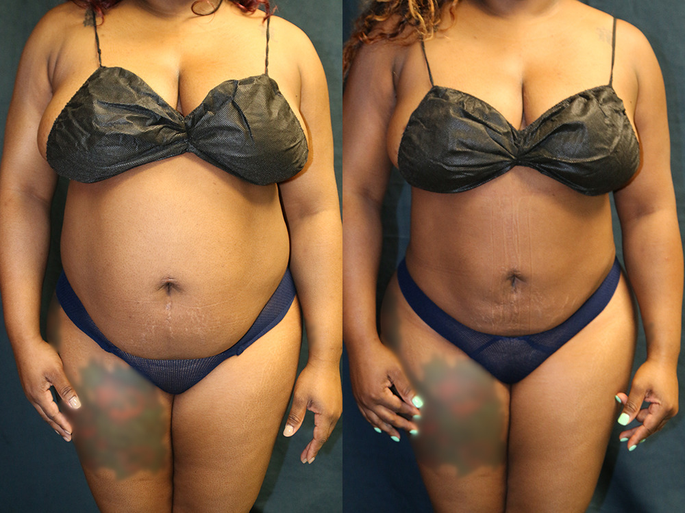 Before and after photo of a liposuction patient.