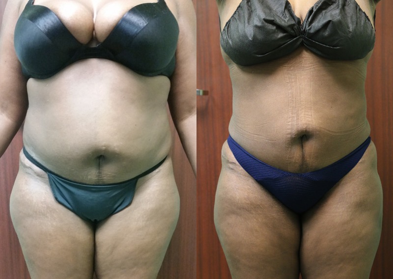 Before and after photo of a liposuction patient.