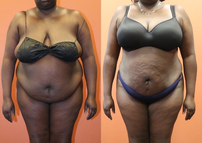 Before and after photo of a liposuction patient.