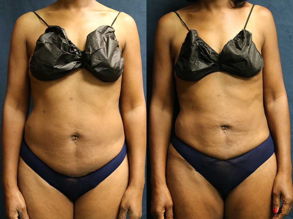 Before and after photo of a liposuction patient.