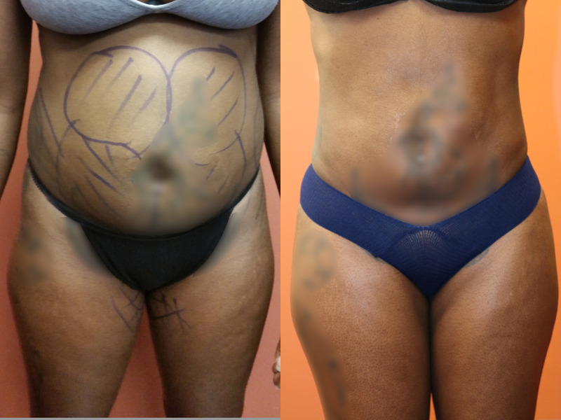 Before and after photo of a liposuction patient.