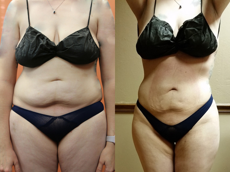 Before and after photo of a liposuction patient.