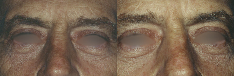 Before and after photo of a blepharoplasty patient.