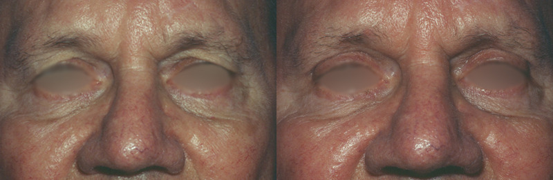 Before and after photo of a blepharoplasty patient.