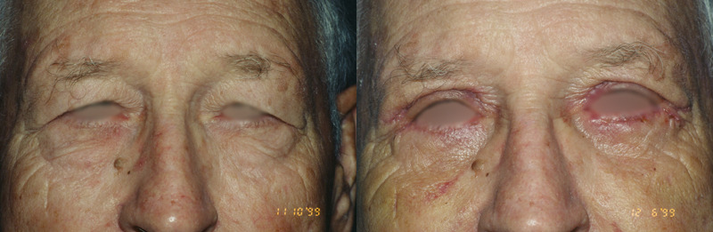 Before and after photo of a blepharoplasty patient.