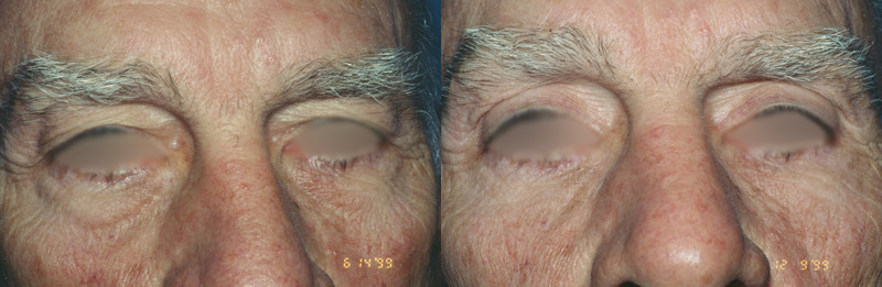 Before and after photo of a blepharoplasty patient.