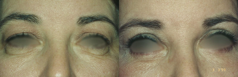 Before and after photo of a blepharoplasty patient.