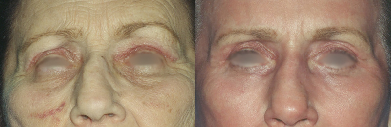 Before and after photo of a blepharoplasty patient.