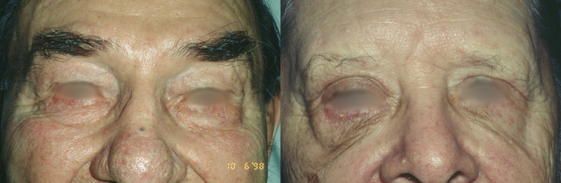 Before and after photo of a blepharoplasty patient.