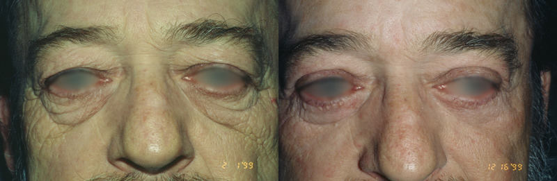 Before and after photo of a blepharoplasty patient.