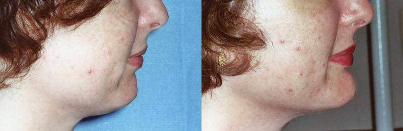 Before and after photo of a chin augmentation patient.