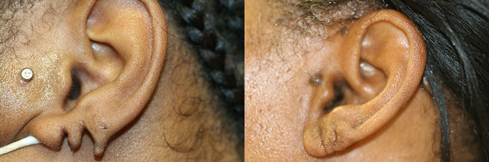 torn earlobe, Earlobe Repair, Memphis TN Olive Brance MS Little Rock AR