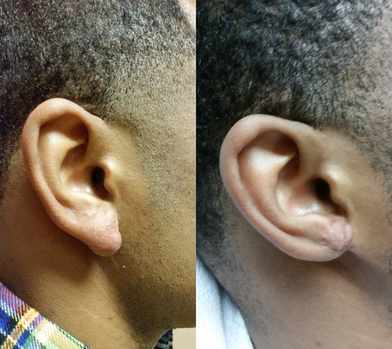 Before and after photo of a keloid patient.