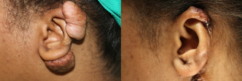 Before and after photo of a keloid patient.