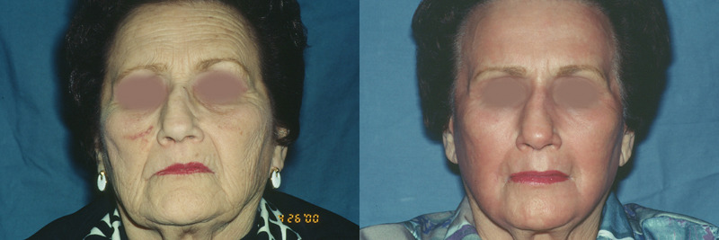 Before and after photo of a laser treatment patient.