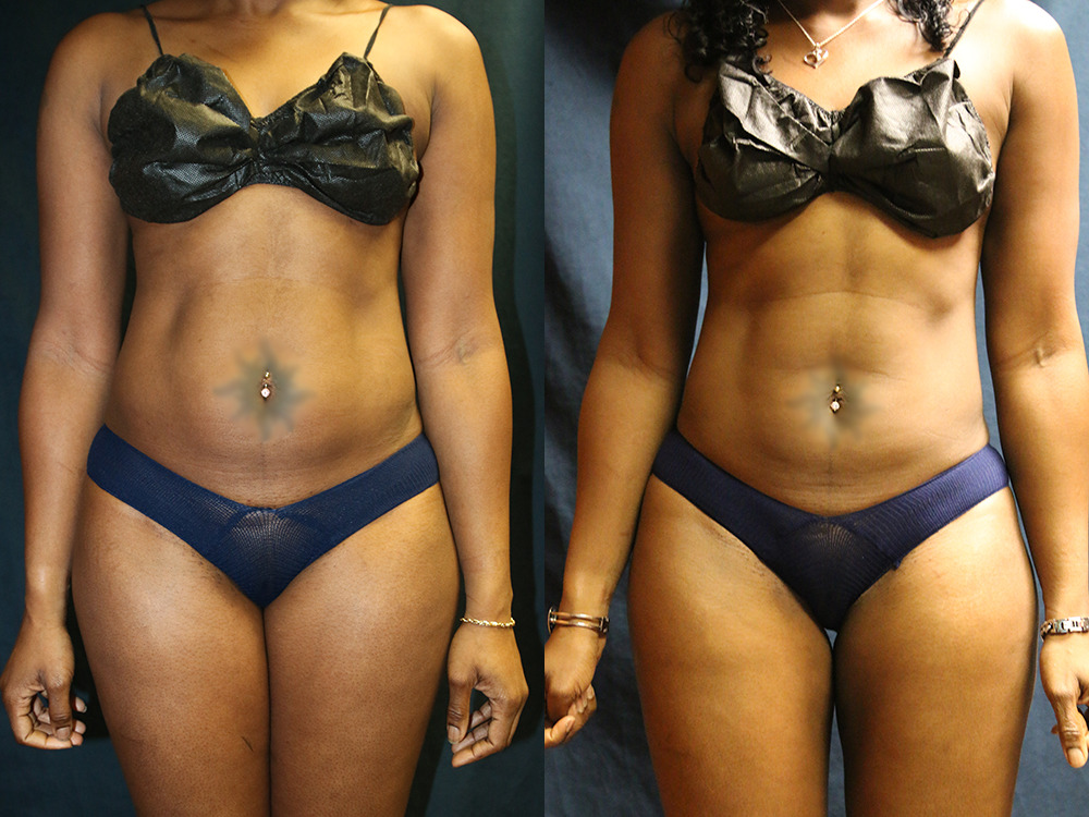 Before and after photo of a liposuction patient.