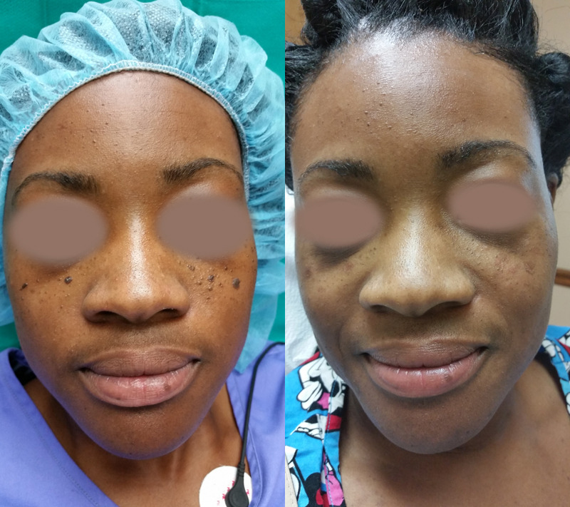 Before and after image of a Nevi mole removal patient.