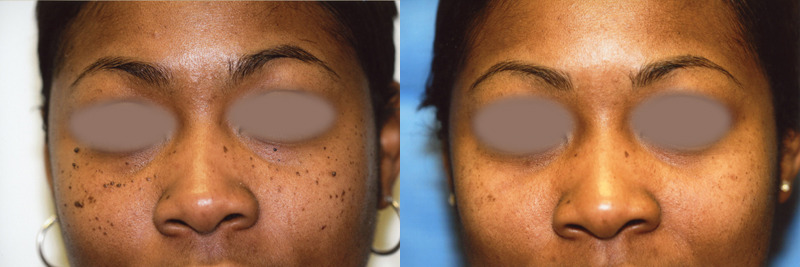 Before and after image of a Nevi mole removal patient.