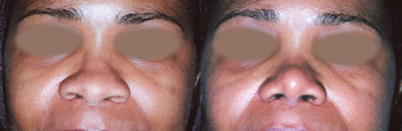 Before and after image of a rhinoplasty patient.
