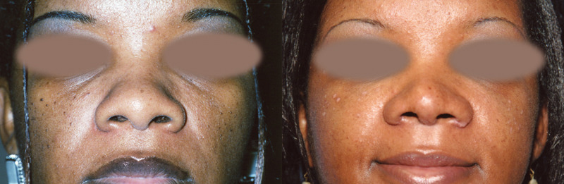 Before and after image of a rhinoplasty patient.