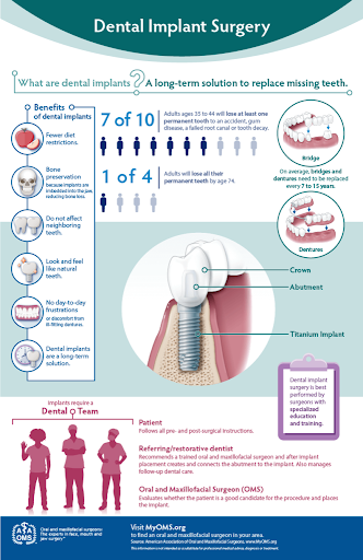 dental implant surgery dental implant surgery info graphic