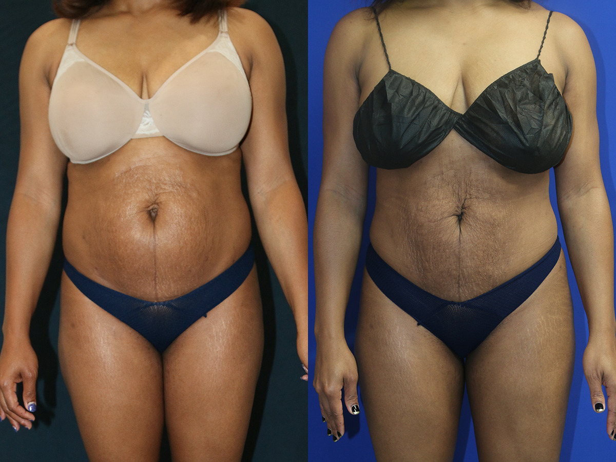 Liposuction Before and After Photo by Dr. Williams in Southfield Memphis