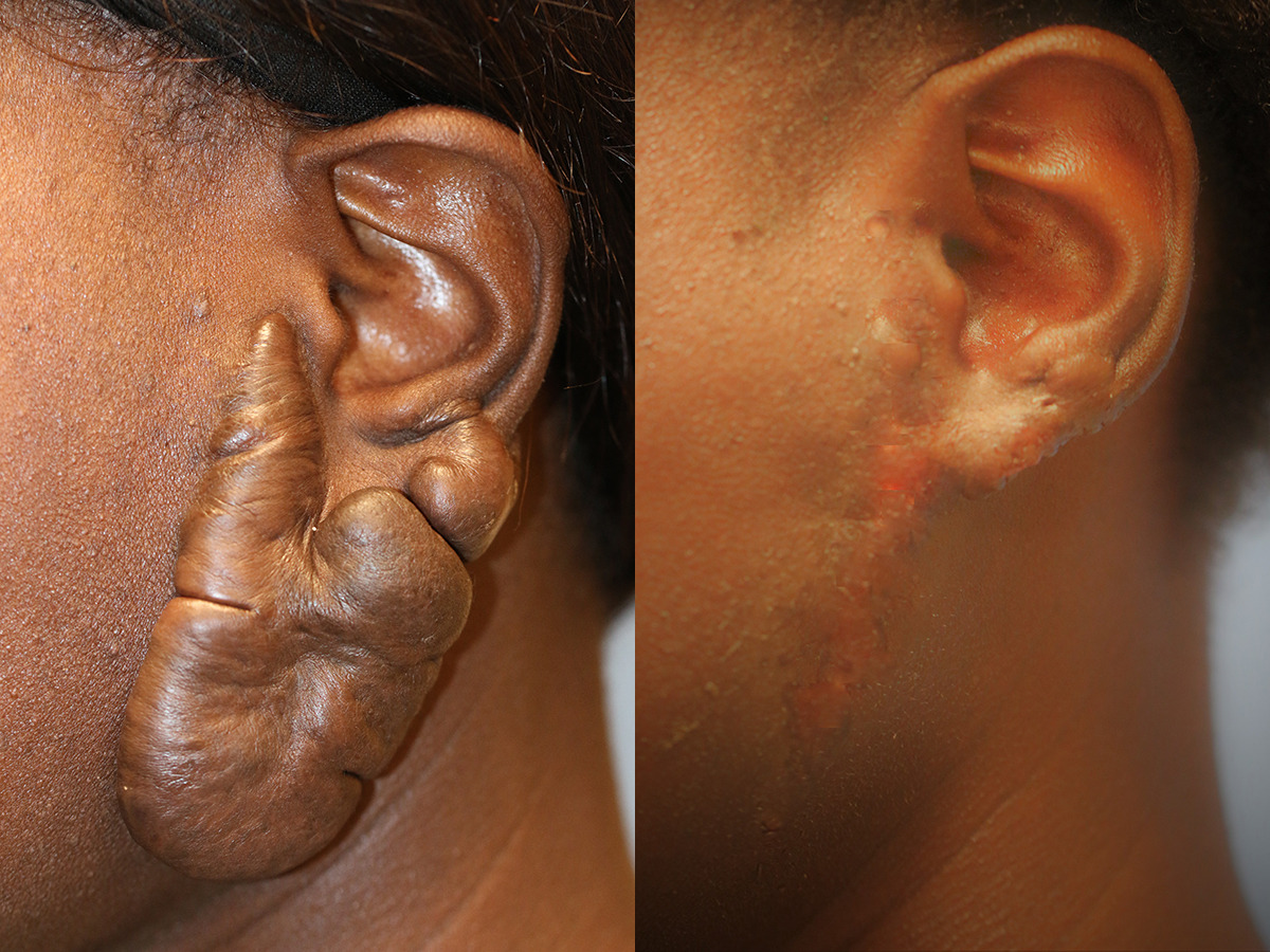 Keloids Before and After Photo by Dr. Williams in Southfield Memphis
