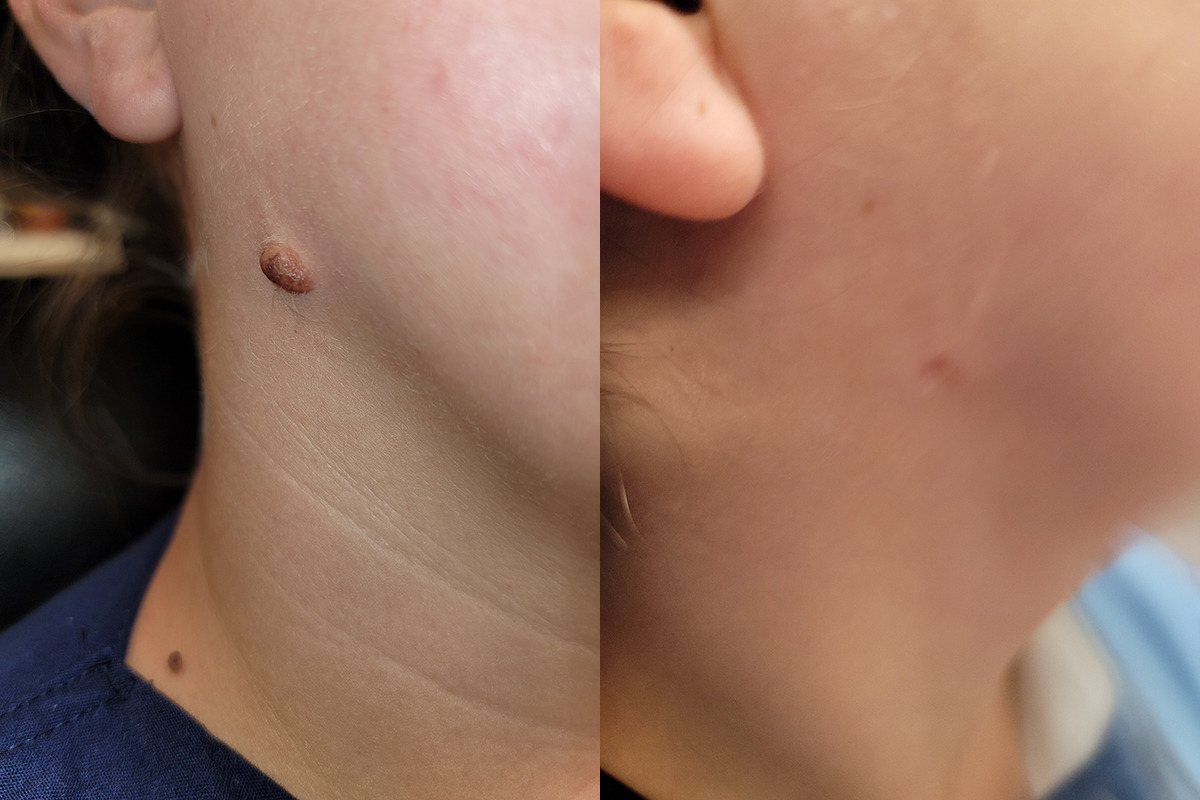 Nevi Mole Removal Before and After Photo by Dr. Williams in Southfield Memphis