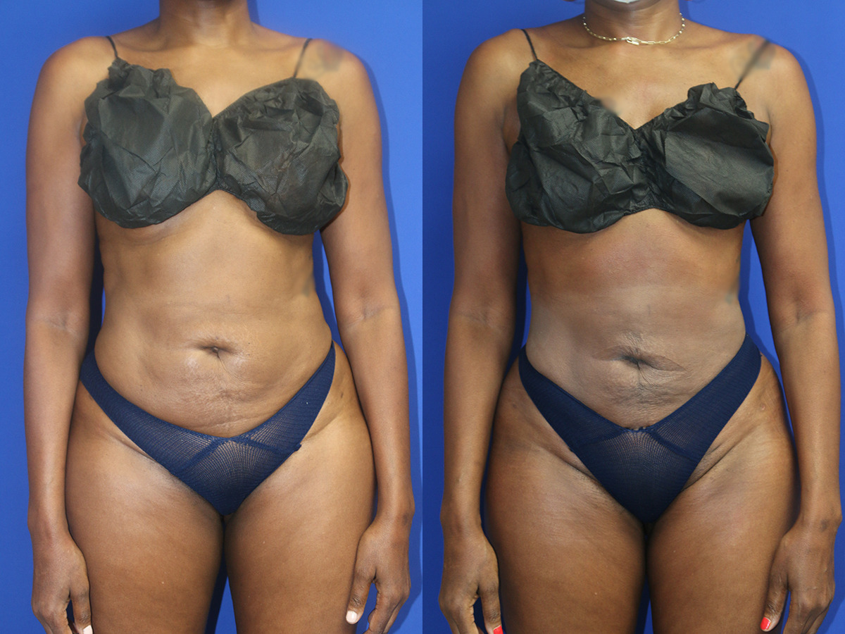 Liposuction Before and After Photo by Dr. Williams in Memphis