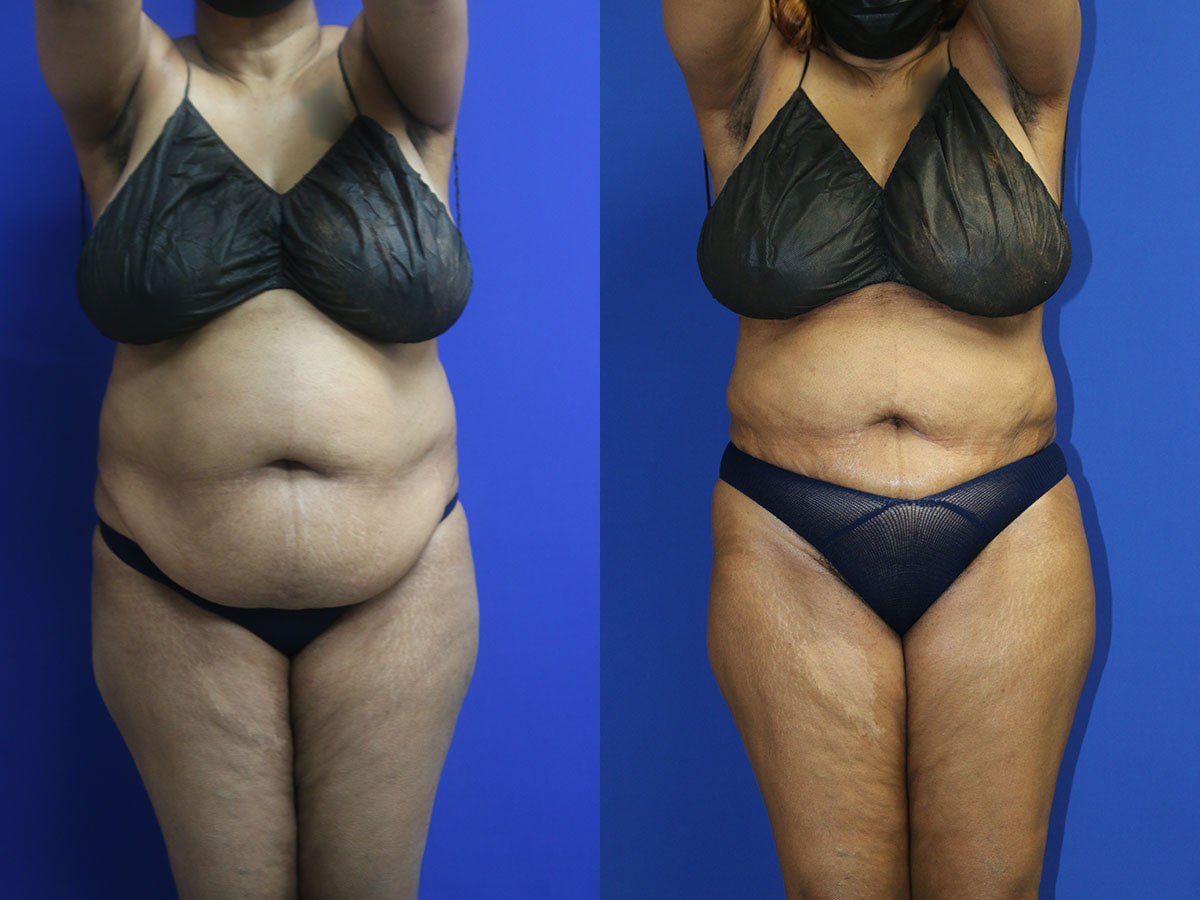 Liposuction Before and After Photo by Dr. Williams in Memphis