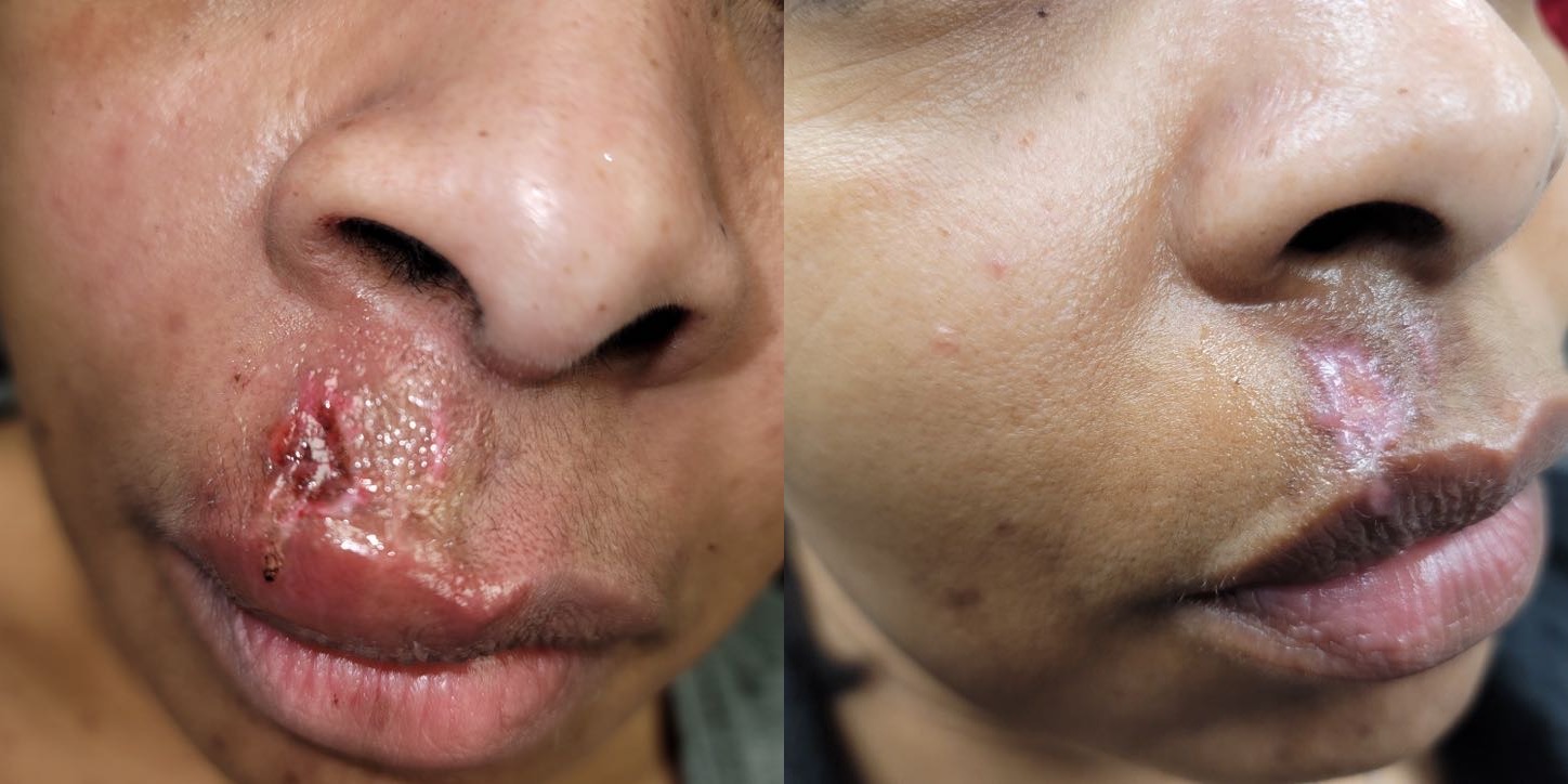 Skin Revision Before and After Photo by Dr. Williams in Memphis Tennessee