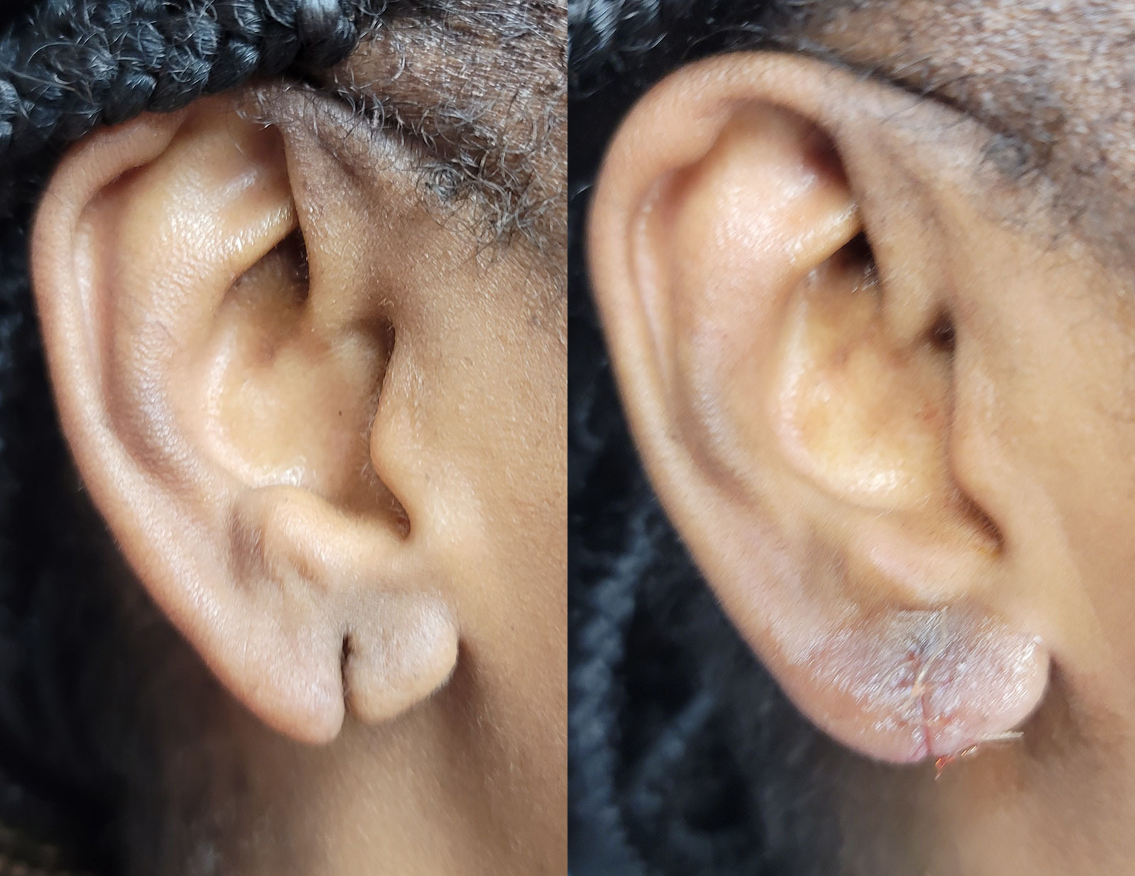 Earlobe Repair Before and After Photo by Dr. Williams in Memphis Tennessee